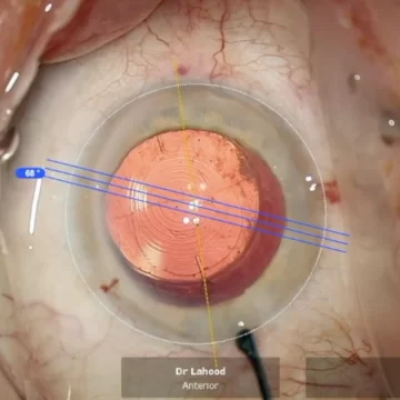 dr ben lahood auscrs presentation