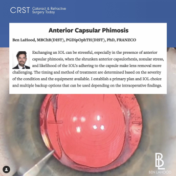 Anterior Capsular Phimosis
