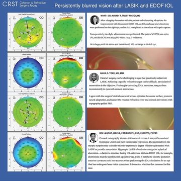 Cataract and Refractive Surgery Diagram